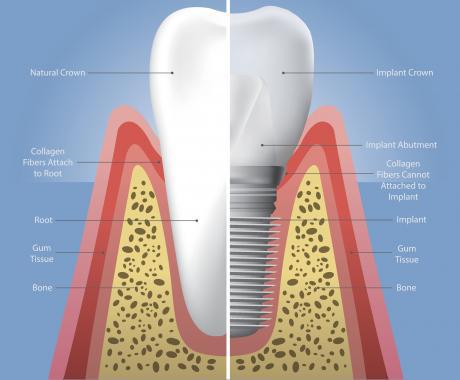 Dental Implant graphic showing cross section of a tooth.